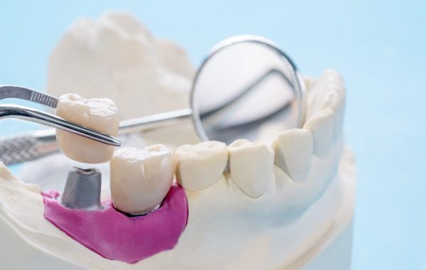 Closeup / Implant Prosthodontics or Prosthetic / Tooth crown and bridge implant dentistry equipment and model express fix restoration.
